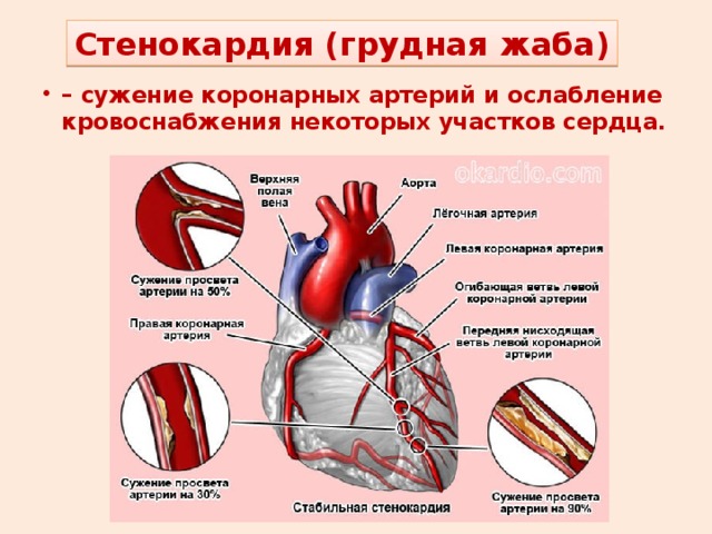 Стенокардия это простыми словами у мужчин. Стенокардия грудная жаба. Сужение коронарных артерий. Сужение просвета коронарных артерий.