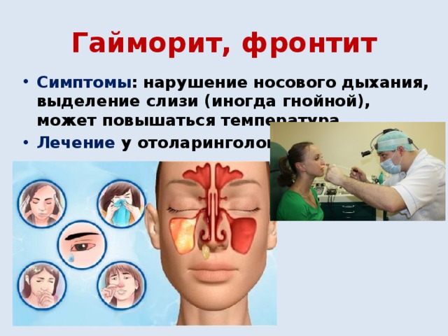 Гайморит, фронтит Симптомы : нарушение носового дыхания, выделение слизи (иногда гнойной), может повышаться температура. Лечение у отоларинголога.  