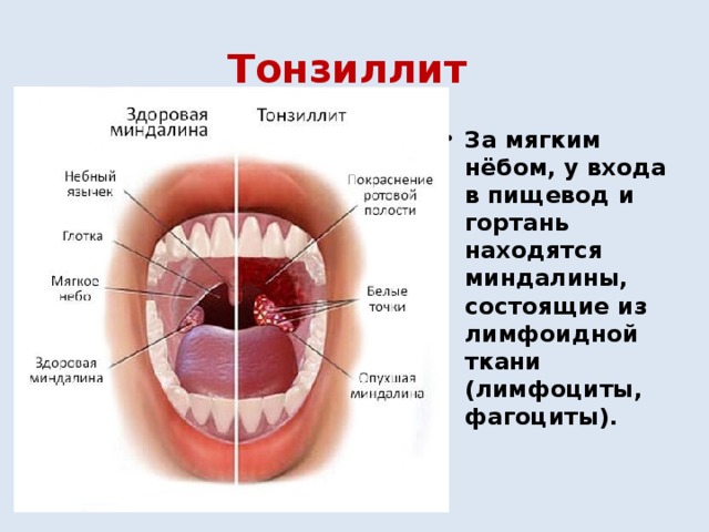 Тонзиллит  За мягким нёбом, у входа в пищевод и гортань находятся миндалины, состоящие из лимфоидной ткани (лимфоциты, фагоциты). 