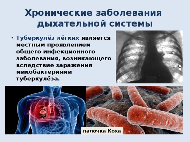 Хронические заболевания дыхательной системы Туберкулёз лёгких является местным проявлением общего инфекционного заболевания, возникающего вследствие заражения микобактериями туберкулёза. палочка Коха 