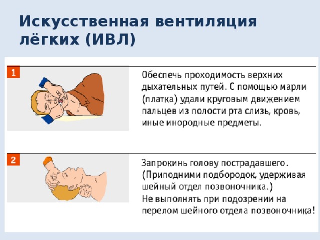 Искусственная вентиляция лёгких (ИВЛ) 