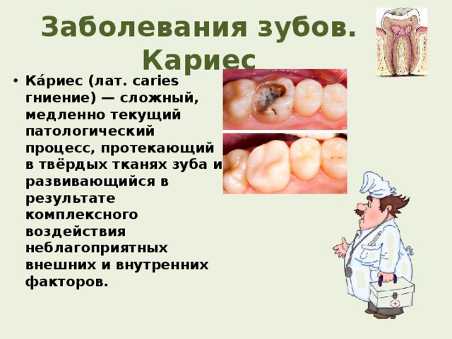Заболевания зубов. Кариес Ка́риес (лат. caries гниение) — сложный, медленно текущий патологический процесс, протекающий в твёрдых тканях зуба и развивающийся в результате комплексного воздействия неблагоприятных внешних и внутренних факторов. 