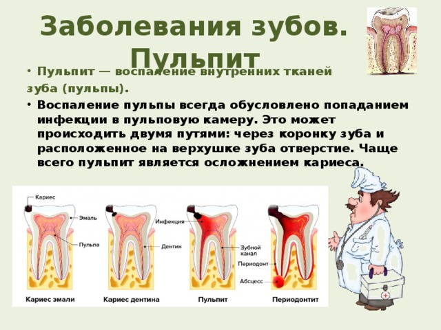 Заболевания зубов. Пульпит Пульпит  — воспаление внутренних тканей зуба (пульпы). Воспаление пульпы всегда обусловлено попаданием инфекции в пульповую камеру. Это может происходить двумя путями: через коронку зуба и расположенное на верхушке зуба отверстие. Чаще всего пульпит является осложнением кариеса. 