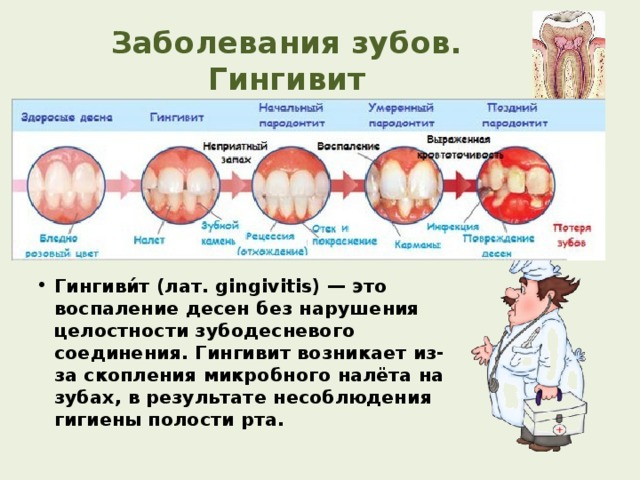 Заболевания зубов. Гингивит Гингиви́т (лат. gingivitis) — это воспаление десен без нарушения целостности зубодесневого соединения. Гингивит возникает из-за скопления микробного налёта на зубах, в результате несоблюдения гигиены полости рта. 