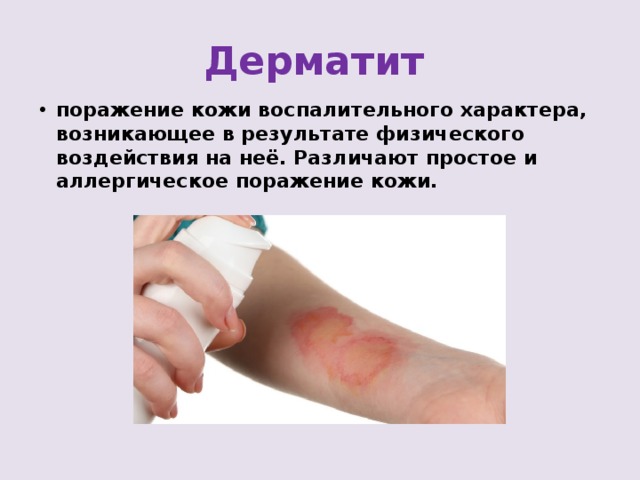 Дерматит  поражение кожи воспалительного характера, возникающее в результате физического воздействия на неё. Различают простое и аллергическое поражение кожи.  