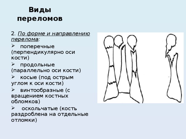 Виды переломов