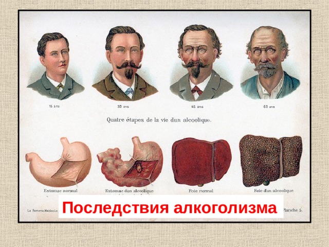 Последствия алкоголизма  