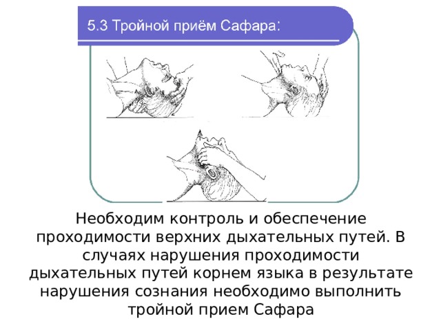 Тройной прием сафара картинки