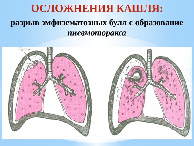 Буллы в легких что это такое. Воздушные Буллы в легких.