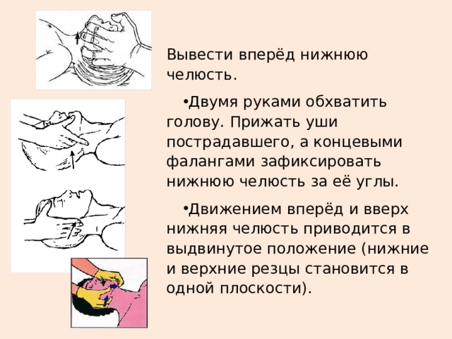 Вывести вперёд нижнюю челюсть. Двумя руками обхватить голову. Прижать уши пострадавшего, а концевыми фалангами зафиксировать нижнюю челюсть за её углы. Движением вперёд и вверх нижняя челюсть приводится в выдвинутое положение (нижние и верхние резцы становится в одной плоскости). 