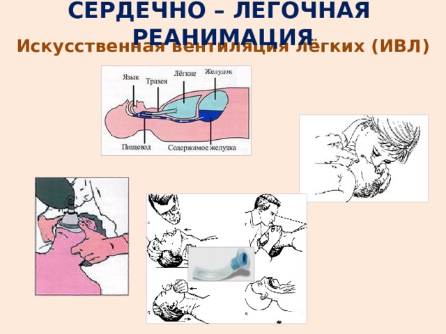 СЕРДЕЧНО – ЛЕГОЧНАЯ РЕАНИМАЦИЯ Искусственная вентиляция лёгких (ИВЛ) 