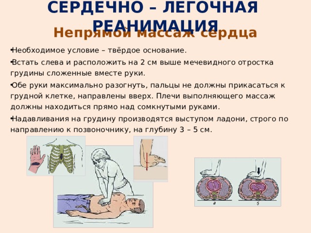 СЕРДЕЧНО – ЛЕГОЧНАЯ РЕАНИМАЦИЯ Непрямой массаж сердца Необходимое условие – твёрдое основание. Встать слева и расположить на 2 см выше мечевидного отростка грудины сложенные вместе руки. Обе руки максимально разогнуть, пальцы не должны прикасаться к грудной клетке, направлены вверх. Плечи выполняющего массаж должны находиться прямо над сомкнутыми руками. Надавливания на грудину производятся выступом ладони, строго по направлению к позвоночнику, на глубину 3 – 5 см. 