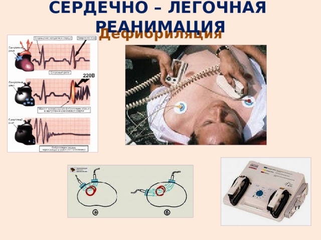 СЕРДЕЧНО – ЛЕГОЧНАЯ РЕАНИМАЦИЯ Дефибриляция 