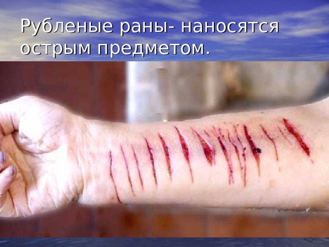 Рубленые раны- наносятся острым предметом. Рубленые раны наносят тяжелым острым предметом (шашка, топор и др.). Для таких ран характерны глубокое повреждение тканей, широкое зияние, ушиб и сотрясение окружающих тканей, снижающие их сопротивляемость и регенеративные способности  
