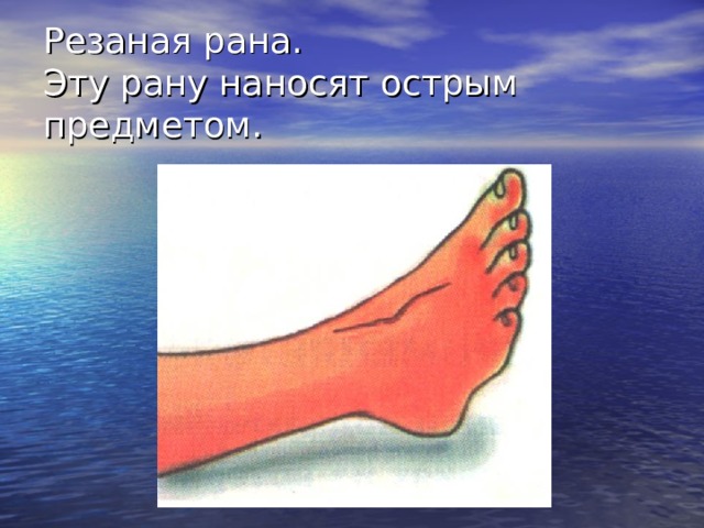 Резаная рана.  Эту рану наносят острым предметом. Резаные раны наносят острым предметом. Они характеризуются набольшим количеством разрушенных клеток; окружающие ткани не повреждаются. Зияние раны позволяет произвести осмотр поврежденных органов и создает хорошие условия для оттока отделяемого. При резаной ране имеются наиболее благоприятные условия для заживления, поэтому, обрабатывая любые свежие раны, их стремятся превратить в резаные.  