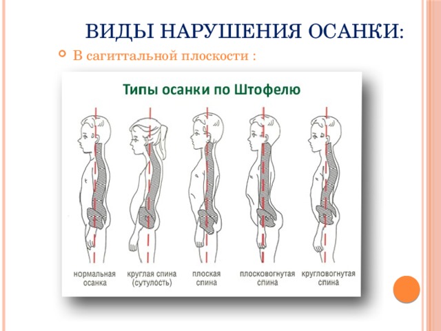 Рассмотрите рисунки 1 4 с изображением типов осанок человека как называют нарушение осанки