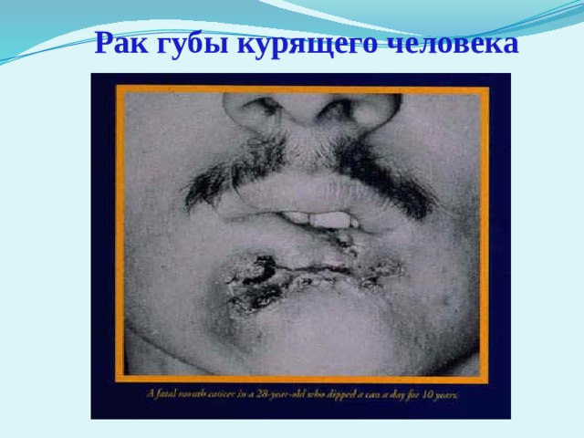  Рак губы курящего человека 