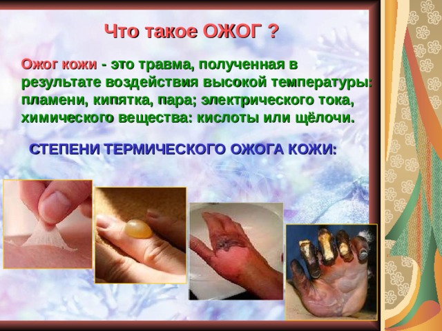 Что такое ОЖОГ ? Ожог кожи - это травма, полученная в результате воздействия высокой температуры: пламени, кипятка, пара; электрического тока, химического вещества: кислоты или щёлочи.   СТЕПЕНИ ТЕРМИЧЕСКОГО ОЖОГА КОЖИ:    