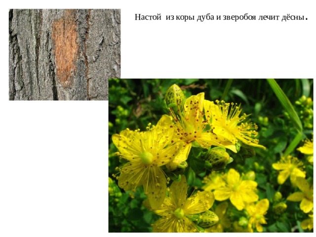 Настой из коры дуба и зверобоя лечит дёсны .