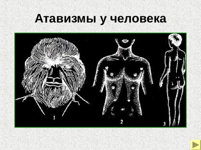Атавизмы у человека Примеры морфологических доказательств эволюции. Атавизмы у человека – густой волосяной покров на лице и теле, развитие дополнительных пар млечных желез, хвостовой придаток.  