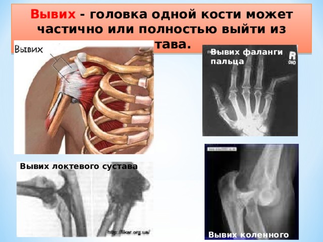 Вывих - головка одной кости может частично или полностью выйти из сустава. Вывих фаланги пальца Вывих локтевого сустава Вывих коленного сустава 