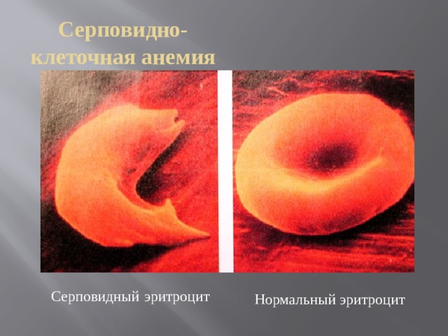 Серповидно-клеточная анемия Серповидный  эритроцит Нормальный эритроцит 