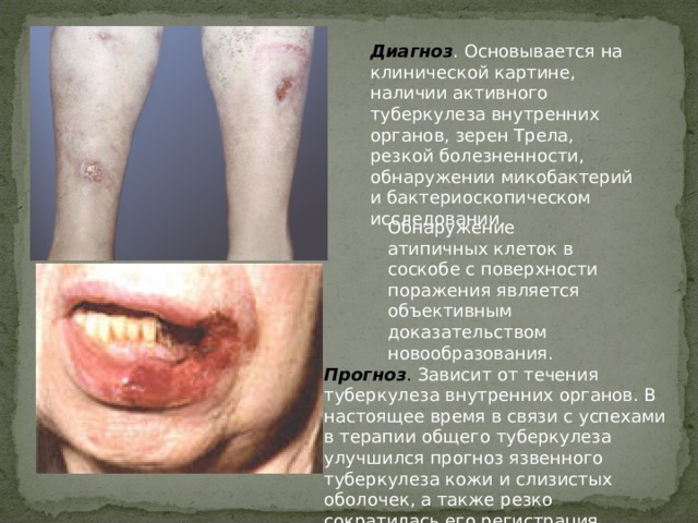 Диагноз . Основывается на клинической картине, наличии активного туберкулеза внутренних органов, зерен Трела, резкой болезненности, обнаружении микобактерий и бактериоскопическом исследовании. Обнаружение атипичных клеток в соскобе с поверхности поражения является объективным доказательством новообразования.     Прогноз . Зависит от течения туберкулеза внутренних органов. В настоящее время в связи с успехами в терапии общего туберкулеза улучшился прогноз язвенного туберкулеза кожи и слизистых оболочек, а также резко сократилась его регистрация. 
