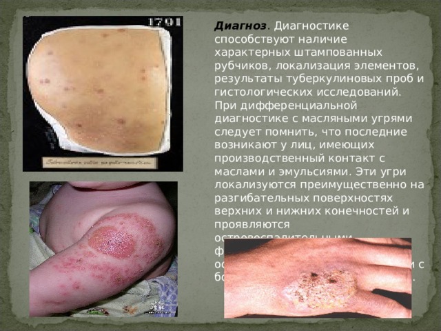 Диагноз . Диагностике способствуют наличие характерных штампованных рубчиков, локализация элементов, результаты туберкулиновых проб и гистологических исследований. При дифференциальной диагностике с масляными угрями следует помнить, что последние возникают у лиц, имеющих производственный контакт с маслами и эмульсиями. Эти угри локализуются преимущественно на разгибательных поверхностях верхних и нижних конечностей и проявляются островоспалительными фолликулитами или остиофолликулитами в сочетании с большим количеством комедонов. 