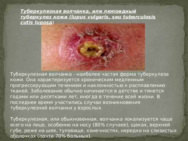 Туберкулезная волчанка, или люпоидный туберкулез кожи (lupus vulgaris, seu tuberculosis cutis luposa )   Туберкулезная волчанка - наиболее частая форма туберкулеза кожи. Она характеризуется хроническим медленным прогрессирующим течением и наклонностью к расплавлению тканей. Заболевание обычно начинается в детстве и тянется годами или десятками лет, иногда в течение всей жизни. В последнее время участились случаи возникновения туберкулезной волчанки у взрослых.   Туберкулезная, или обыкновенная, волчанка локализуется чаще всего на лице, особенно на носу (80% случаев), щеках, верхней губе, реже на шее, туловище, конечностях, нередко на слизистых оболочках (почти 70% больных). 