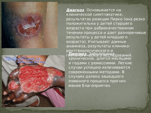 Диагноз . Основывается на клинической симптоматике, результатах реакции Пирке (она резко положительна у детей старшего возраста при доброкачественном течении процесса и дает разноречивые результаты у детей младшего возраста). Учитывают данные анамнеза, результаты клинико-рентгенологического и гистологического исследований. Прогноз . Заболевание хроническое, длится месяцами и годами с ремиссиями. Легкие случаи успешно излечиваются современными методами. В случаях далеко зашедшего язвенного процесса прогноз менее благоприятен. 