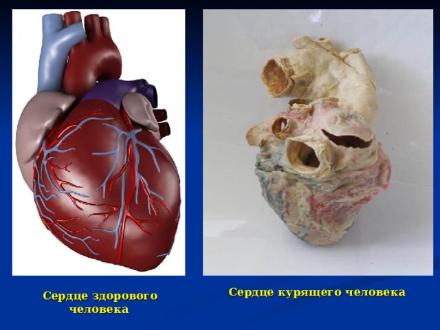 Сердце курящего человека  Сердце здорового человека  