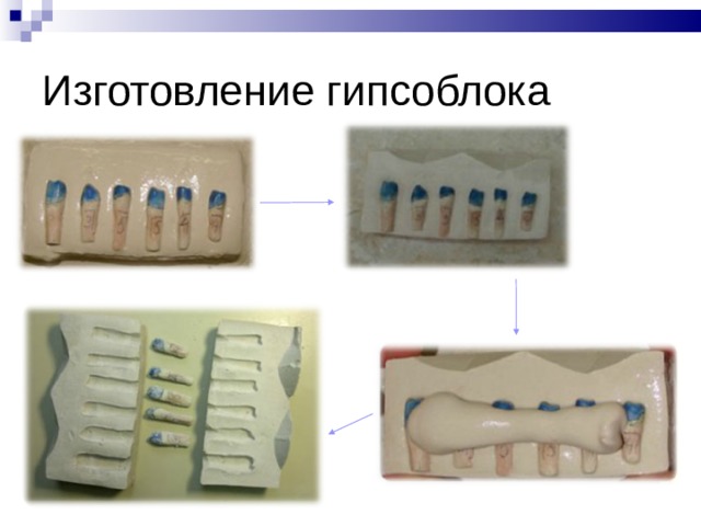 Изготовление штампованной коронки презентация