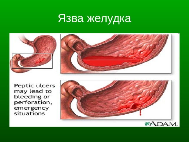 Язва желудка 