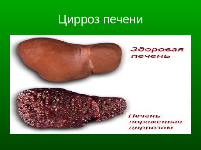 Цирроз печени 