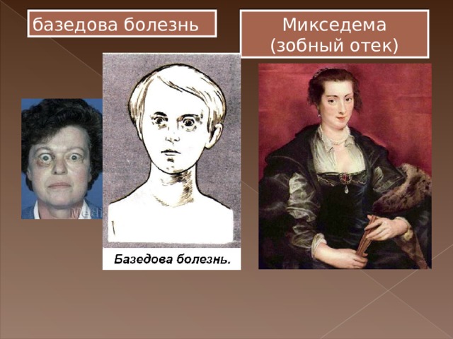 Базедова болезнь это. Базедовая болезнь и микседема. Актеры с базедова болезнь. Базедова болезнь в детском возрасте.