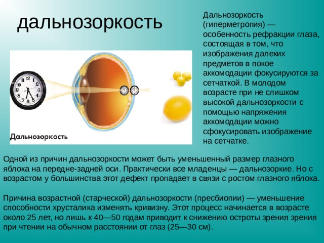 дальнозоркость Дальнозоркость (гиперметропия) — особенность рефракции глаза, состоящая в том, что изображения далеких предметов в покое аккомодации фокусируются за сетчаткой. В молодом возрасте при не слишком высокой дальнозоркости с помощью напряжения аккомодации можно сфокусировать изображение на сетчатке. Одной из причин дальнозоркости может быть уменьшенный размер глазного яблока на передне-задней оси. Практически все младенцы — дальнозоркие. Но с возрастом у большинства этот дефект пропадает в связи с ростом глазного яблока. Причина возрастной (старческой) дальнозоркости (пресбиопии) — уменьшение способности хрусталика изменять кривизну. Этот процесс начинается в возрасте около 25 лет, но лишь к 40—50 годам приводит к снижению остроты зрения зрения при чтении на обычном расстоянии от глаз (25—30 см). 