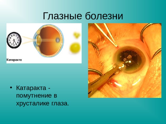 Глазные болезни Катаракта - помутнение в хрусталике глаза. 