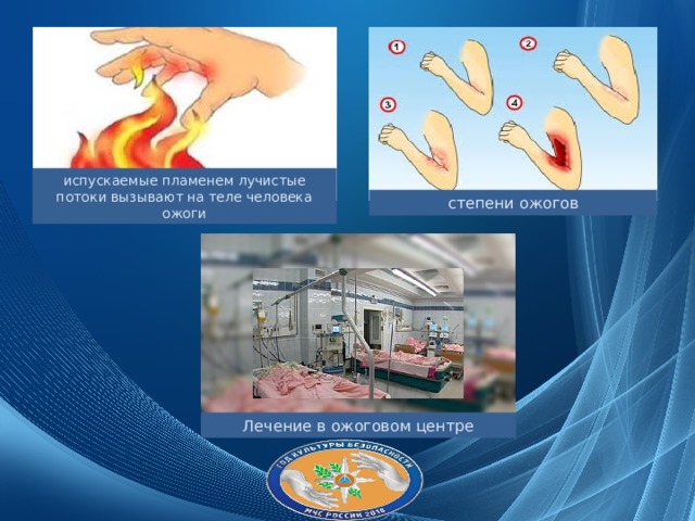 испускаемые пламенем лучистые потоки вызывают на теле человека ожоги степени ожогов Лечение в ожоговом центре 