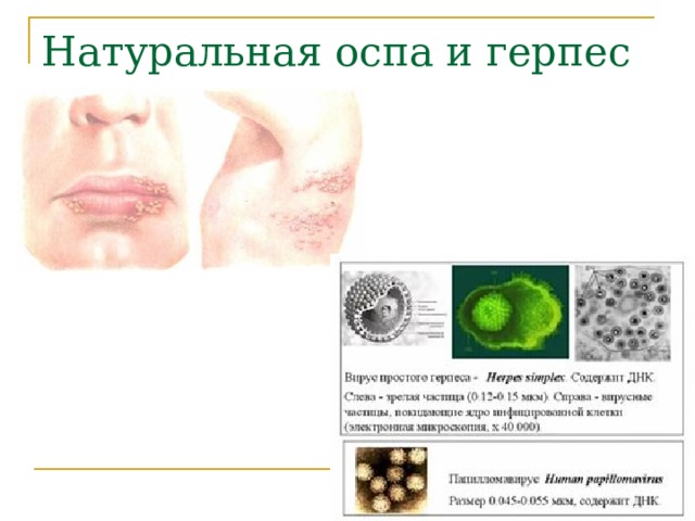 Натуральная оспа  и герпес 