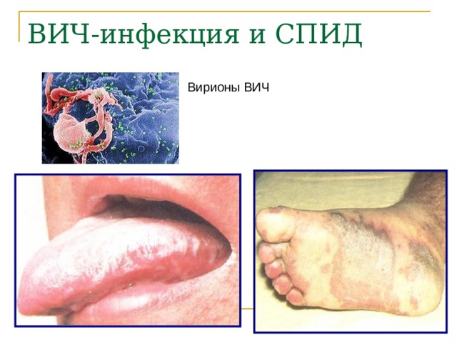 Вирионы ВИЧ 