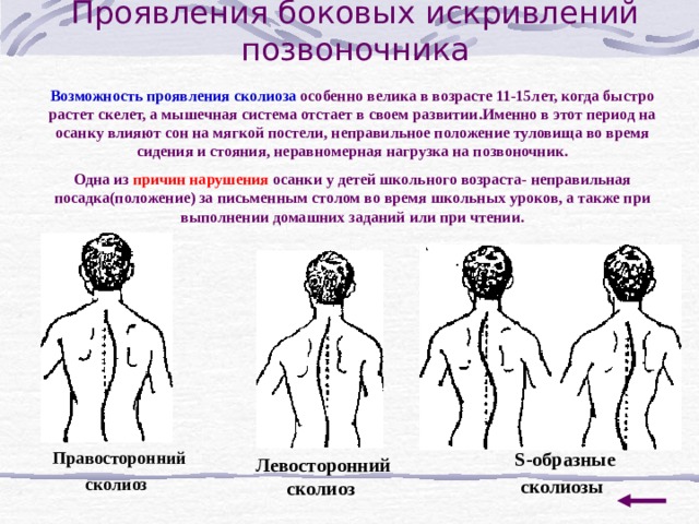 Проявления боковых искривлений позвоночника Возможность проявления сколиоза особенно велика в возрасте 11-15лет, когда быстро растет скелет, а мышечная система отстает в своем развитии.Именно в этот период на осанку влияют сон на мягкой постели, неправильное положение туловища во время сидения и стояния, неравномерная нагрузка на позвоночник. Одна из причин нарушения осанки у детей школьного возраста- неправильная посадка(положение) за письменным столом во время школьных уроков, а также при выполнении домашних заданий или при чтении. Правосторонний сколиоз  S -образные сколиозы  Левосторонний сколиоз  