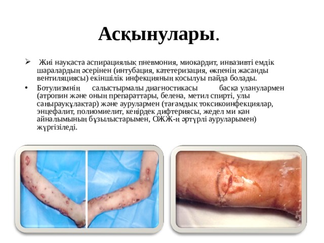 Асқынулары .  Жиі науқаста аспирациялық пневмония, миокардит, инвазивті емдік шаралардың әсерінен (интубация, катетеризация, өкпенің жасанды вентиляциясы) екіншілік инфекцияның қосылуы пайда болады. Ботулизмнің салыстырмалы диагностикасы  басқа уланулармен (атропин және оның препараттары, белена, метил спирті, улы саңырауқұлақтар) және аурулармен (тағамдық токсикоинфекциялар, энцефалит, полиомиелит, кеңірдек дифтериясы, жедел ми қан айналымының бұзылыстарымен, ОЖЖ-ң әртүрлі ауруларымен) жүргізіледі.  