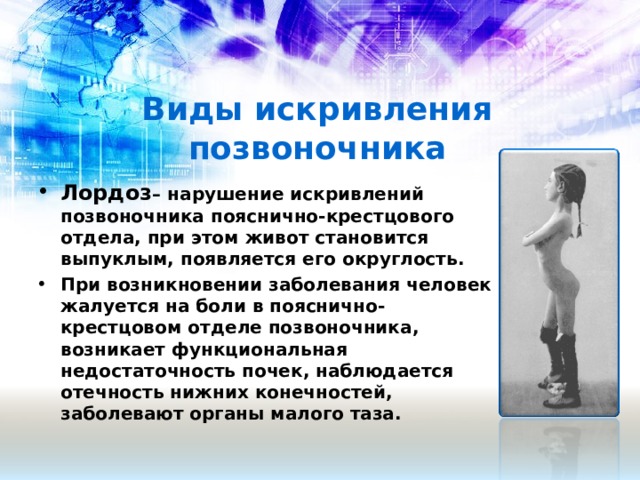 Виды искривления позвоночника Лордоз – нарушение искривлений позвоночника пояснично-крестцового отдела, при этом живот становится выпуклым, появляется его округлость. При возникновении заболевания человек жалуется на боли в пояснично-крестцовом отделе позвоночника, возникает функциональная недостаточность почек, наблюдается отечность нижних конечностей, заболевают органы малого таза.   