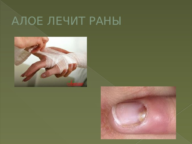 АЛОЕ ЛЕЧИТ РАНЫ 
