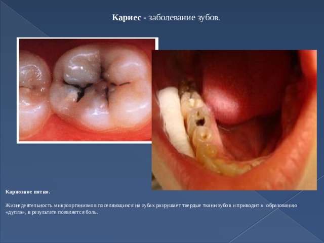 Кариес - заболевание зубов.     Кариозное пятно.  Жизнедеятельность микроорганизмов поселяющихся на зубах разрушает твердые ткани зубов и приводит к образованию «дупла», в результате появляется боль.    