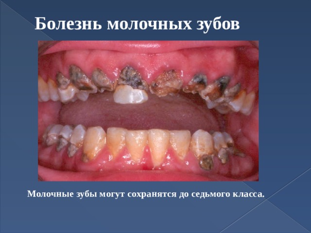 Болезнь молочных зубов   Молочные зубы могут сохранятся до седьмого класса.   