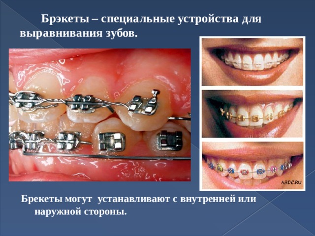  Брэкеты – специальные устройства для выравнивания зубов. Брекеты могут устанавливают с внутренней или наружной стороны. 