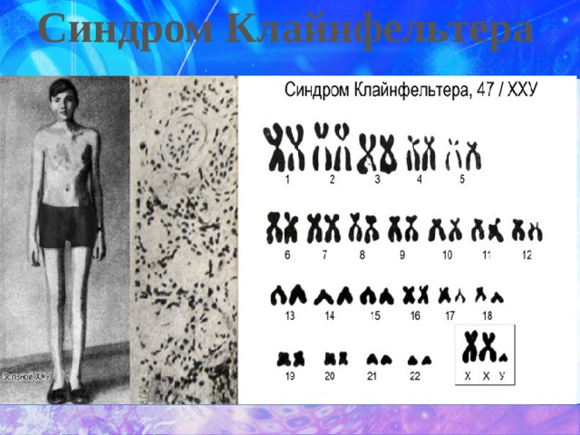 Синдром клайнфельтера картинки