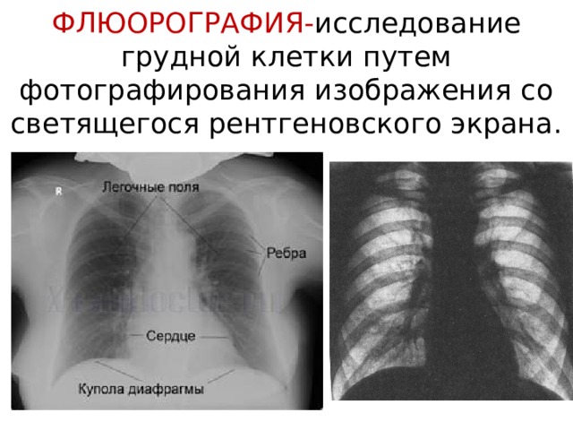 ФЛЮОРОГРАФИЯ- исследование грудной клетки путем фотографирования изображения со светящегося рентгеновского экрана. 