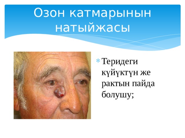 Озон катмарынын натыйжасы Теридеги күйүктүн же рактын пайда болушу; 